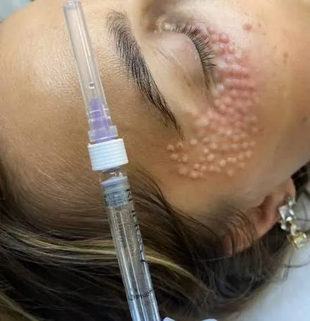 Биоревитализация (премиум: Juvederm/Rejuran) Биоревитализация (премиум: Juvederm/Rejuran)